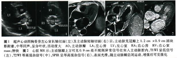 主动脉无冠瓣乳头状弹性纤维瘤一例