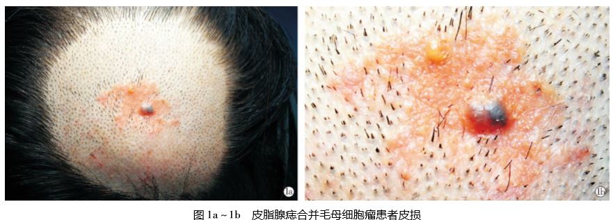 皮脂腺痣合并毛母细胞瘤1 例