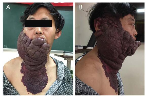 neurology:罕见的伴脑部受压的巨大皮肤蔓状血管瘤