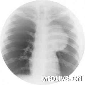 肺癌晚期吃易瑞沙多少时间可复查效果?【肺腺