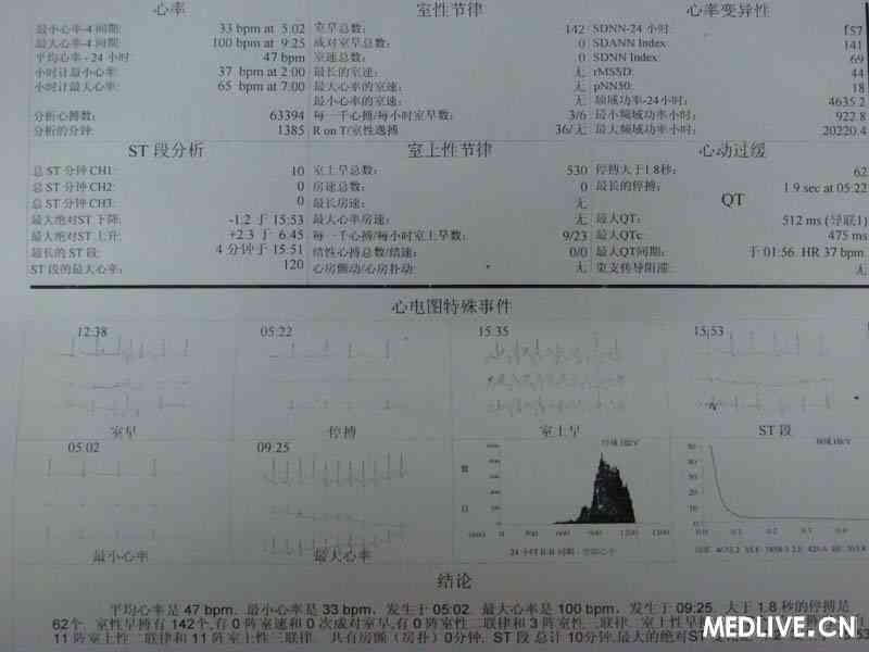 图ECG正常,心率稍快,九十几,心悸触诊心脏跳很