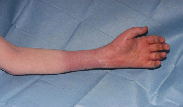 经典病例_病例报告:假性淋巴水肿作为一种精神