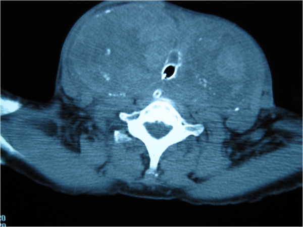 例_【病例报告】 颈部良性多结节性甲状腺肿引