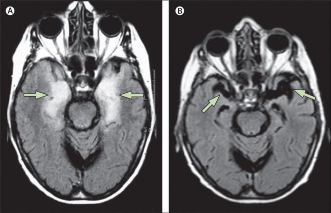 经典病例_病例报告:女性患者边缘叶脑炎致非典
