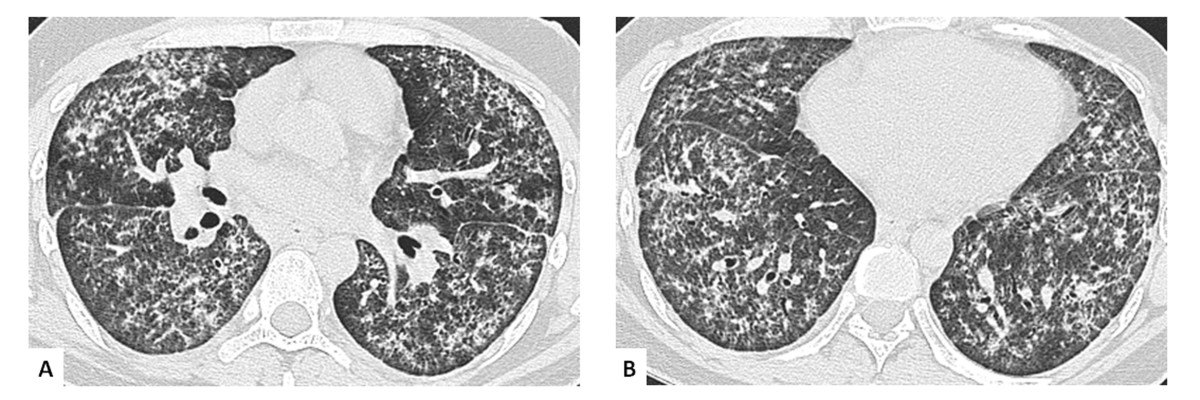 纤维化表现,同时伴有嗜酸性粒细胞浸润,偶见机化性肺炎病灶(见图2a和