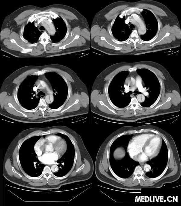 主动脉夹层动脉瘤患者的螺旋CT诊断结果分析