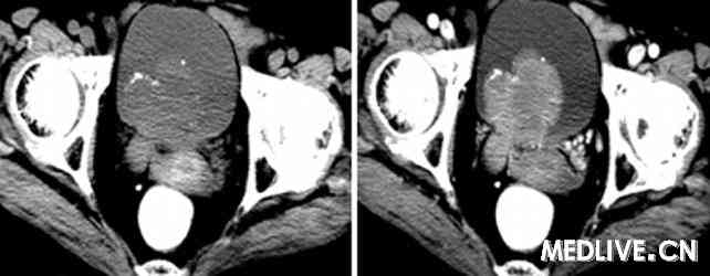 膀胱癌(carcinoma of urinary bladder)ct-超声病例图片影像诊断分析