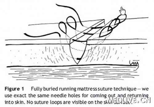 新型皮肤缝合术——全程埋入褥式缝合