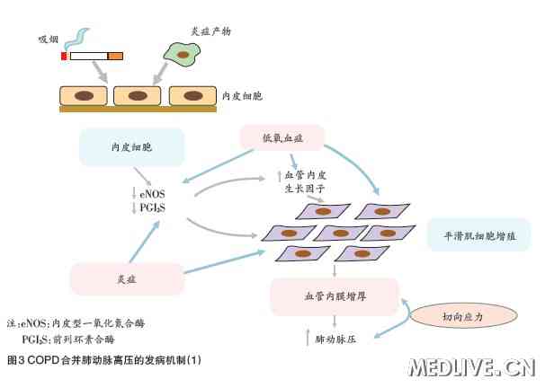 维持性血液透析患者并发肺动脉高压的相关因素分析