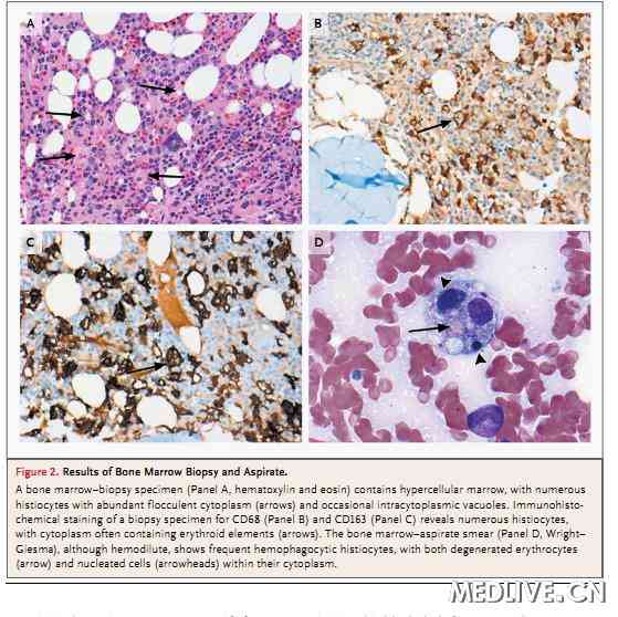 症【病理讨论 骨髓活检标本显示骨髓三系造血细胞增生旺盛