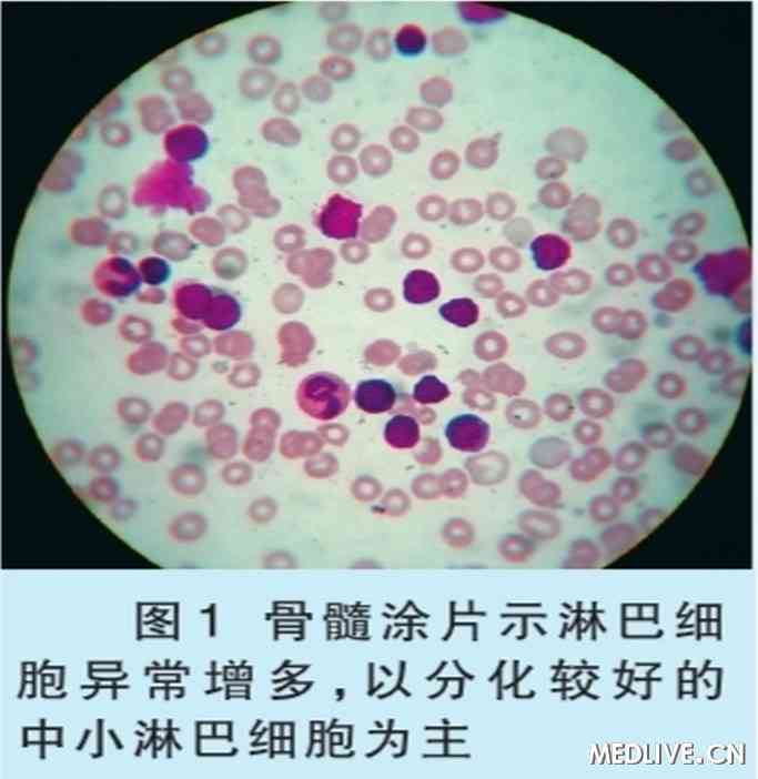 慢性淋巴细胞白血病
