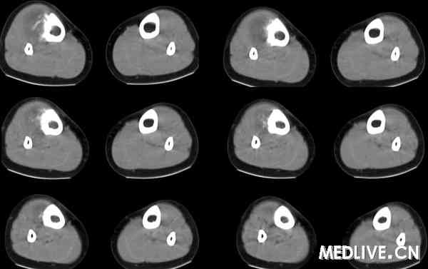 右侧胫骨骨尤文氏肉瘤(ewing"s sarcoma)ct病例图片影像诊断分析