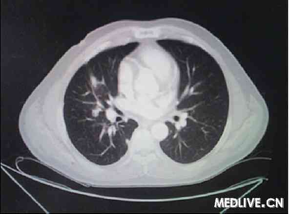 晚期肺癌 ct