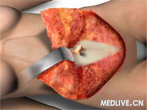 经典病例_高张力腹壁成形术_医脉通_medlive