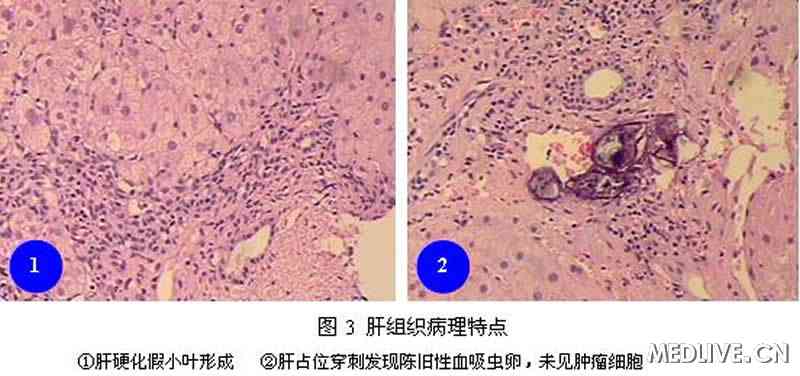 经典病例_乙型肝炎肝硬化伴肝血吸虫病误诊原; 图3 肝炎肝硬化组织