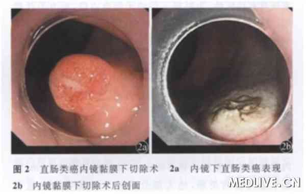 国产内镜下黏膜切除术治疗广基结直肠息肉的体会