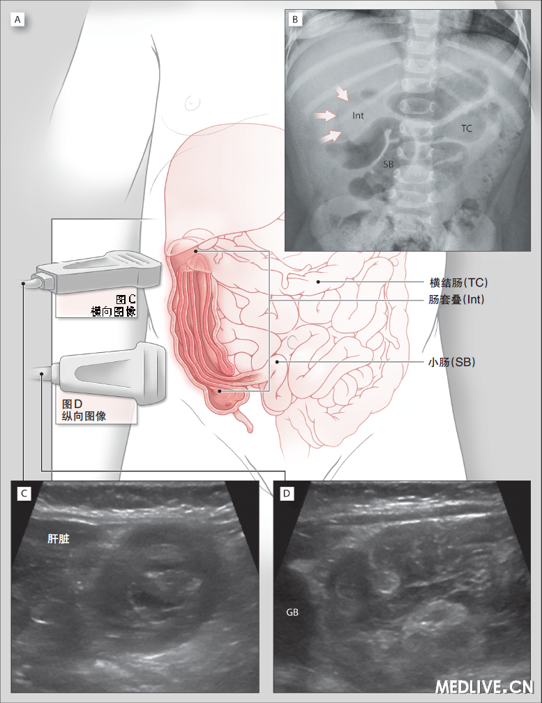 肠套叠的腹部成像