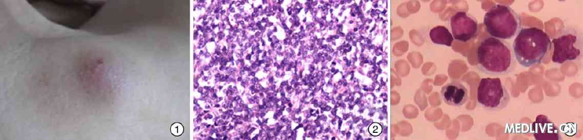 乳瘤头病毒怎么治疗_人乳瘤头病毒治疗多久_头乳瘤病毒58是什么