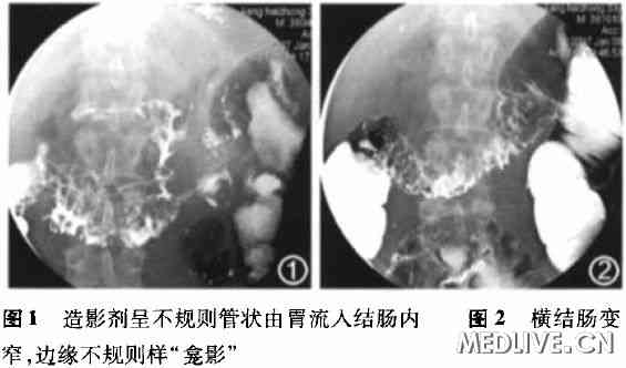 克罗恩病罕见并发症