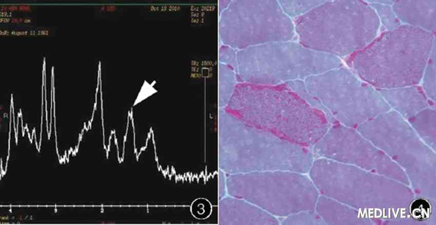 (lac)峰,n-乙酰天门冬氨酸(naa)代谢降低(图3)肌电图扫描右侧肱二头