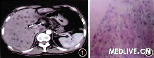 肝脓肿、肝脏炎性假瘤