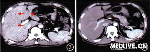 肝脓肿、肝脏炎性假瘤