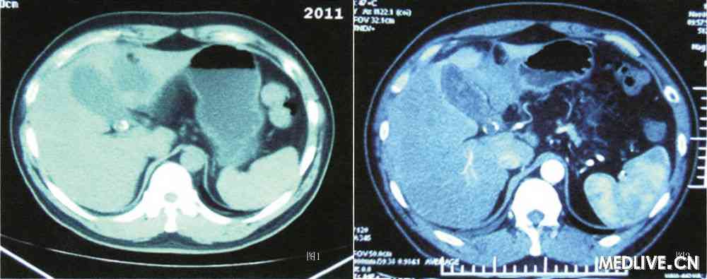胆囊炎合并CA199值异常增高一例 CT检查