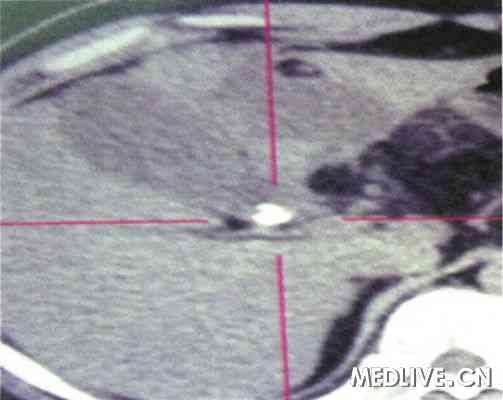 胆囊炎合并CA199值异常增高一例 PET-CT检查
