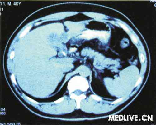 胆囊炎合并CA199值异常增高一例 复查CT