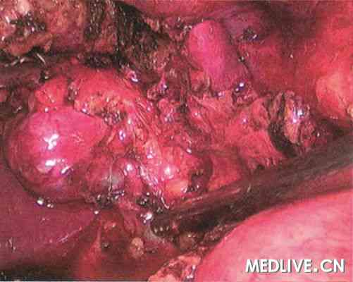 胆囊炎合并CA199值异常增高一例 腹腔镜胆囊切除术