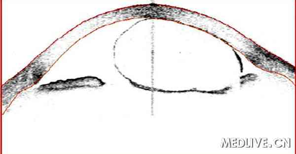 眼前节oct确诊虹膜囊肿.