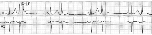 房性期前收缩真三联律,第二个期前收缩未下传.