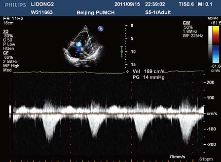 彩色超声心动图评价心肌梗死恢复期经皮冠状动脉介入治疗对左心室重构