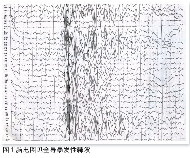 2011年11月16日发作脑电图(图1)证实为癫痫,同时记录的心电图显示为窦