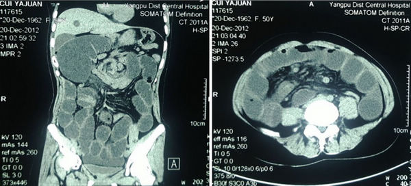 小肠系膜裂孔疝致升结肠嵌顿1例