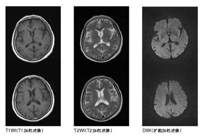 偏瘫,莫忘鉴别低血糖