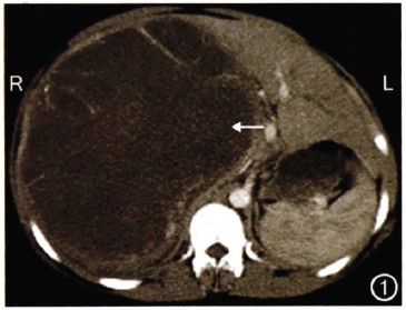 肝脏未分化胚胎性肉瘤一例