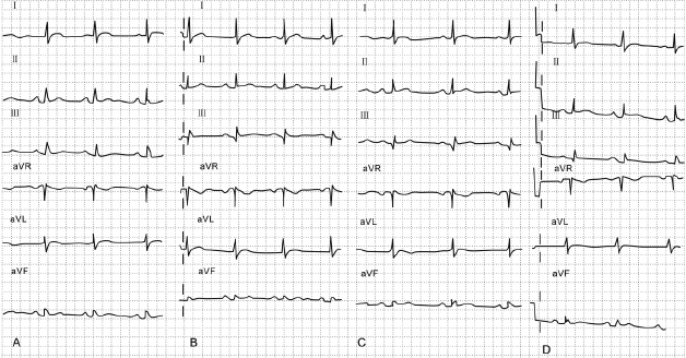 365医学网 学术文章 正文 回旋支闭塞时,典型的心电图改变为下壁