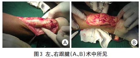 医学新闻 正文  双小腿mri 示:双跟腱增粗,明显肿胀,周围可见片样等t1