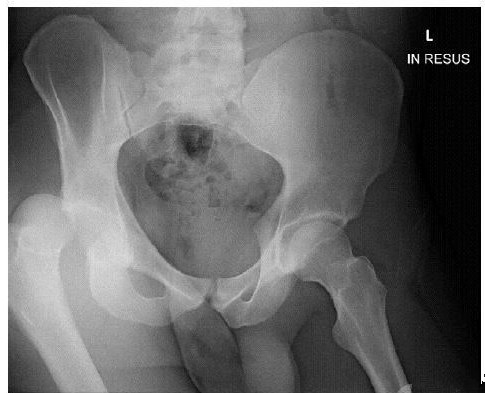 经典病例_创伤性髋关节后脱位致股神经麻痹_