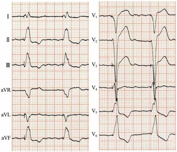 右室心尖部起搏(v1,v2导联呈qs型,v3-6导联均呈rs型,为不典型完全
