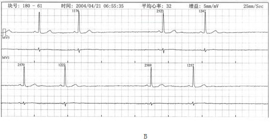 图ab中p-qrs-t波群依次出现为窦性心搏,p-r间期0.