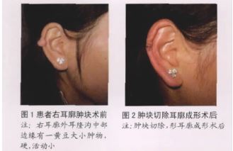 耳廓皮肤纤维瘤1例