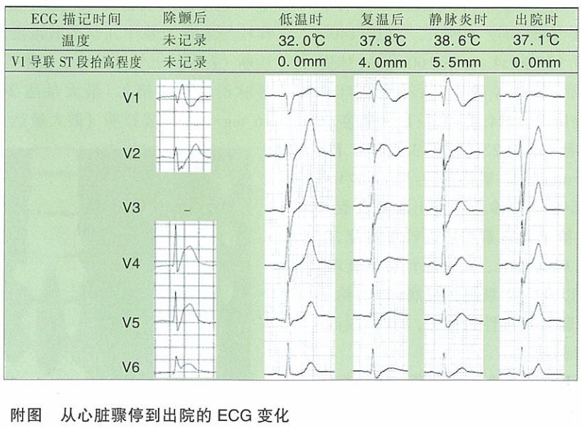 被治疗性低温掩盖的致死性心电图改变