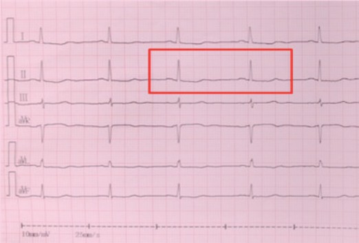 经典病例_从临床诊治过程看NSTEMI的全科临
