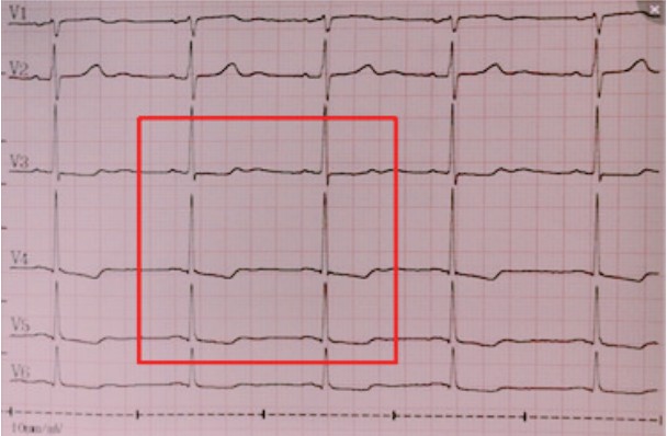 该患者心电图示v3~v5导联st段下移加深