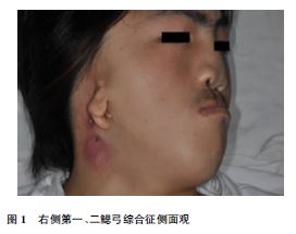 第一,二鳃弓综合征1例