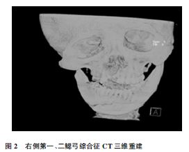 第一,二鳃弓综合征1例