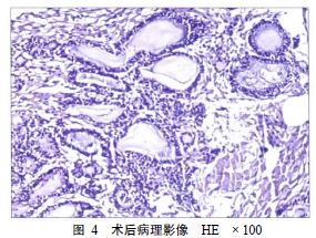 少见!下颌骨成釉细胞15年后瘤颊部异位复发