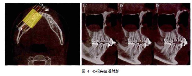 2 mm透射影(图 牙根形成,根尖孔缩小,根尖区域无透射影像